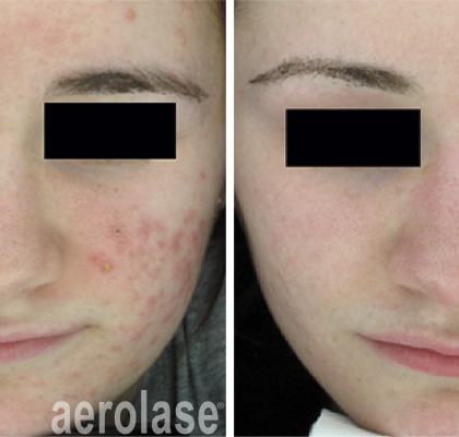 NeoClear Acne - 3 Months After 5 Treatments - David Goldberg MD