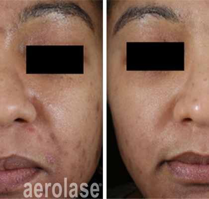 NeoClear Acne - 5 Months After 3 Treatments - David Goldberg MD