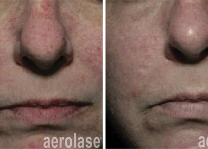 aerolase-NeoSkin Rosacea and Veins - After 2 Treatments - David Goldberg MD