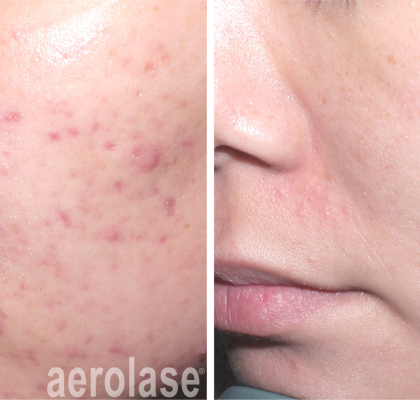 aerolase-acne-spade-before-after-watermark-6-treatments