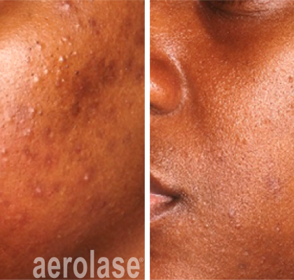 aerolase-before-after-michelle-henry-4-treatments