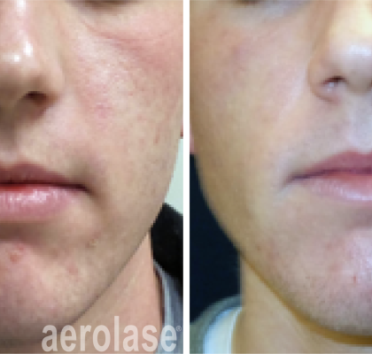 aerolase-kevin-pinski-acne-skin-rejuvenation