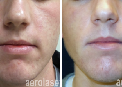 aerolase-kevin-pinski-acne-skin-rejuvenation