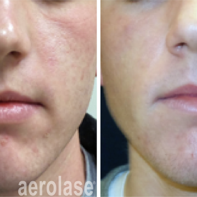 aerolase-kevin-pinski-acne-skin-rejuvenation