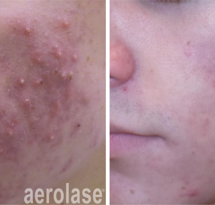 aerolase-kevin-pinski-before-after-acne-4-treatments