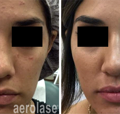 aerolase-mark-nestor-acne-2-months-after-4-treatments