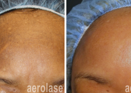 aerolase-melasma-before-after-cheryl-burgess-1-treatment