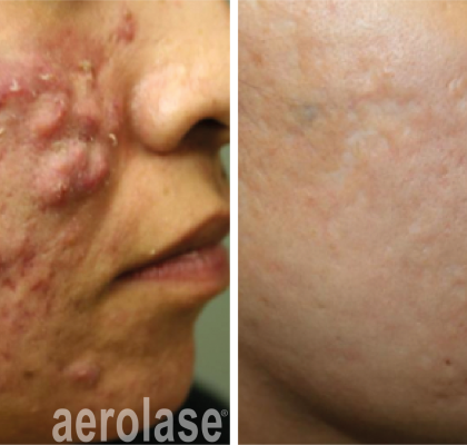 aerolase-michael-gold-acne-5-treatments