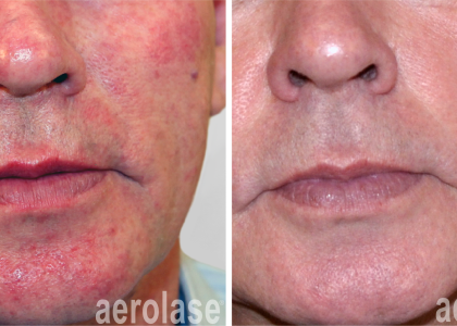 aerolase-neoskin Rosacea - After 2 Treatments - Natalia Geraskova MD