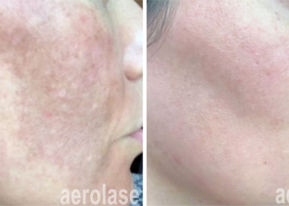 aerolase-neoskin-melasma-Rachel Lowe, LE, Yael Halaas, MD, FACS