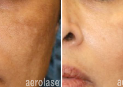 aerolase-neoskin-melasma-after-1-treatment-cheryl-burgess