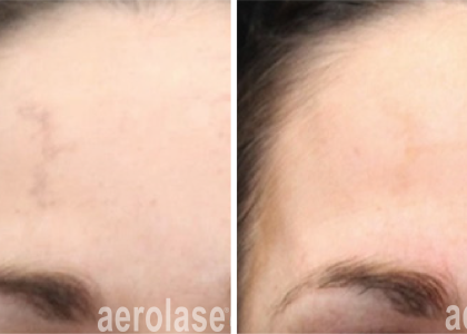 aerolase-neoskin-melasma-after-1-treatment-combined-with-salicylic-peel-suneel-chilukuri