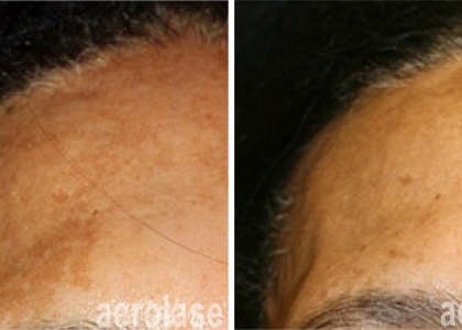 aerolase-neoskin-melasma-after-1-treatment-combined-with-tca-peel-cheryl-burgess