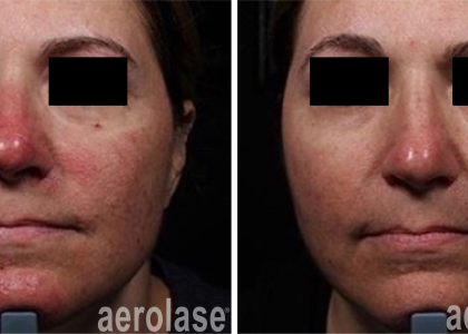 aerolase-neoskin-rosacea-1-week-after-1-treatment-one-aesthetics