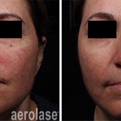 aerolase-neoskin-rosacea-1-week-after-1-treatment-one-aesthetics