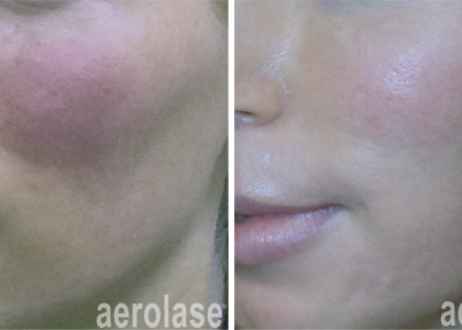 aerolase-neoskin-rosacea-kevin-pinski-after-1-treatment