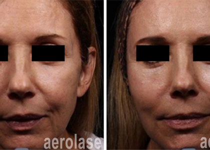 aerolase-neoskin-skin-rejuvenation-after-2-treatments-combined-with-threads-and-filler-one-aesthetics