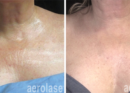 aerolase-neoskin-skin-rejuvenation-after-4-treatments-jason-emer