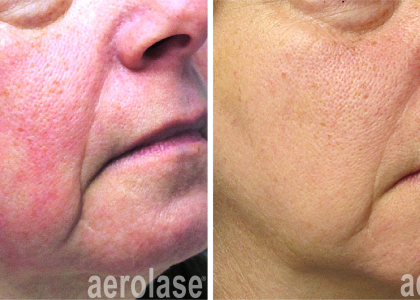 aerolase-rosacea-yelena-kipervas-1-treatment