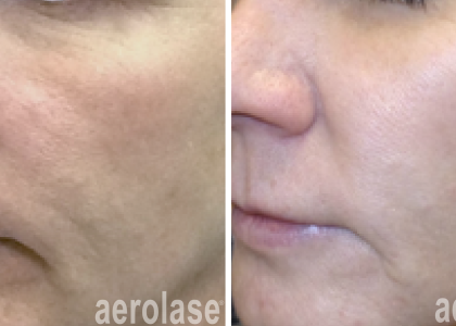 aerolase-skin-rejuvenation-before-after-kevin-pinski-4-treatments