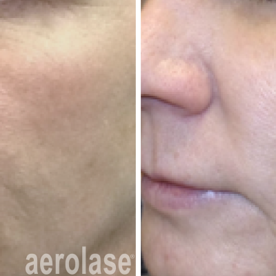 aerolase-skin-rejuvenation-before-after-kevin-pinski-4-treatments