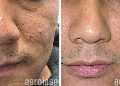 aerolase-skin-rejuvenation-fran cook bolden-after-7-treatments